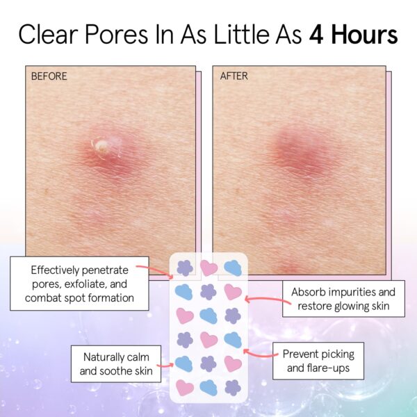 grace & stella Pimple Patches for Face - Cute Hydrocolloid Dots That Help Protect Acne & Reduce - Image 5