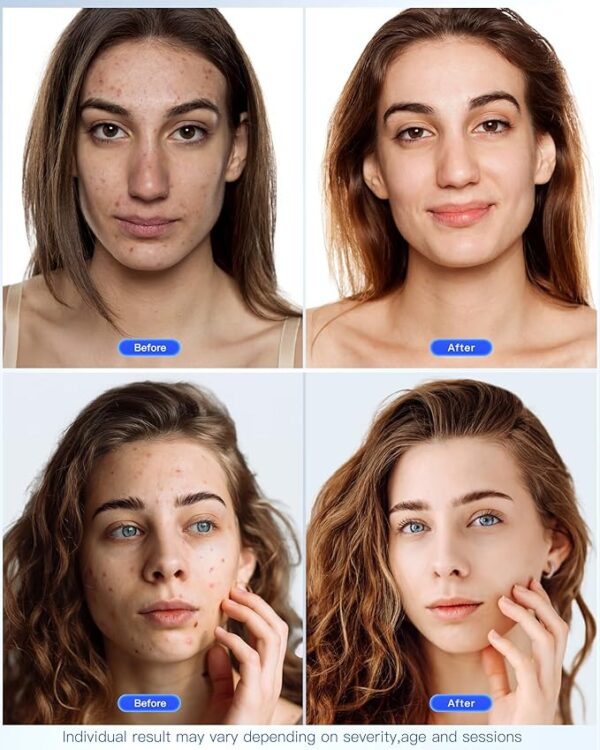 Face Mask Light Therapy,Red Light Therapy for Face Wrinkle Blue Light -15% $128.25 $128.25 per count($128.25 / count) Typical price: $150.89Typical price: $150.89 - Image 5